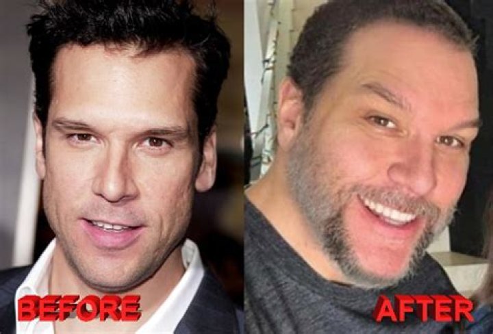 Dane Cook Plastic Surgery