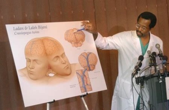 In 1987, Carson performed only successful surgery by separating conjoined twins.